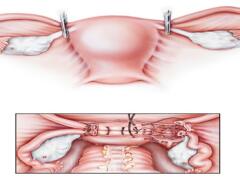 can u lose weight after hysterectomy can u lose weight after hysterectomy